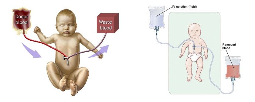 What Is Exchange Transfusion In Hindi